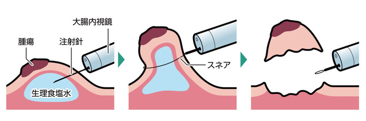 内視鏡的粘膜切除術（EMR）　図解