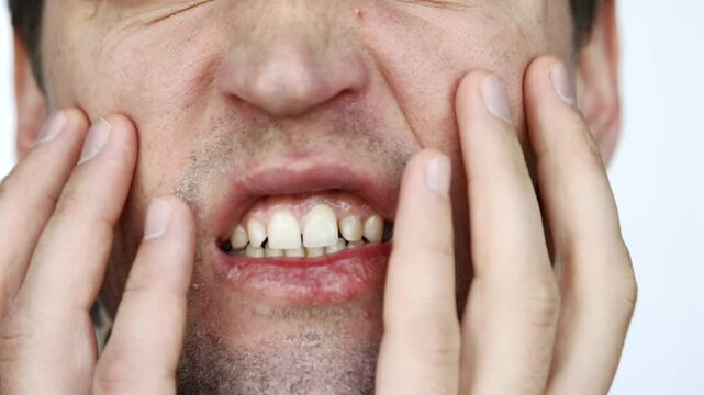 Close-up of a man angrily scratching his irritated, flaky skin with his hands. Side effect of using acne medication: dry skin, chapped lips, itching.