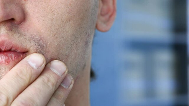 This close-up video captures a man demonstrating dry, peeling skin and chapped lips. Perfect for skincare, beauty, and health topics, it highlights the importance of hydration and skincare routines.