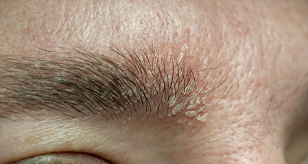 Dandruff psoriasis eczema infection on the eyebrows of a young adult. Macro shot of an eyebrow with Seborrheic Dermatitis skin condition. 
 Skin problem and facial psoriasis concept.