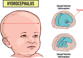 Hydrocephalus brain cerebrospinal fluid (CSF) drain head spina autism cerebral palsy myelomeningocele baby obstructive pediatric neurology birth defects