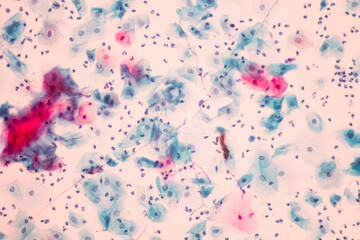 View in microscopic of Candidiasis, fungus infection (Yeast and Pseudohyphae form) in pap smear...