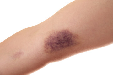 Woman with bruise on arm against white background, closeup