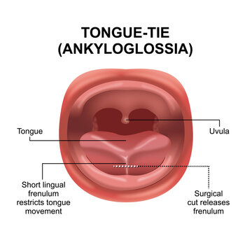 Tongue-Tie (Ankyloglossia) on baby's tongue illustration