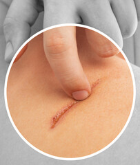 Large scar on human body close-up. Skin scar removal.
