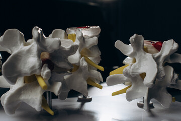 Spine model on a dark background at a physiotherapist’s desk, emphasizing advanced treatment...