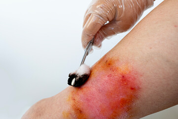 doctor's hands smearing medicine on damaged skin on female limb, chronic dermatitis, wound on...