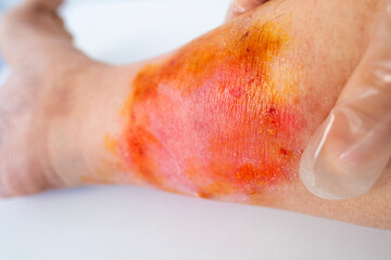 doctor's hands feeling injured female limb with chronic dermatitis, wound on painful female leg,...