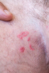 Close up male leg with visible severe scabies mite damage, mite burrows and irritated skin groin...