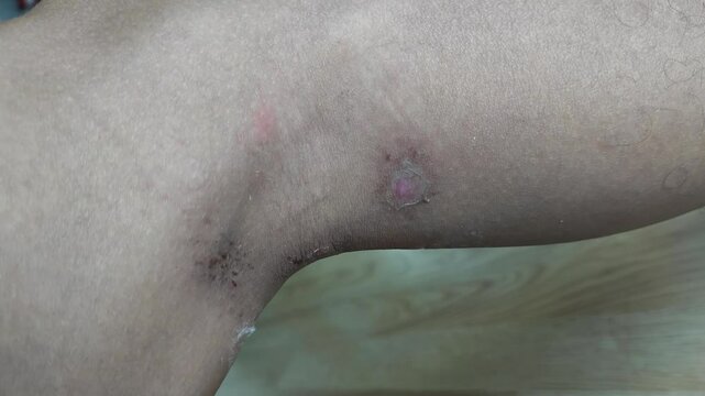 Paederus dermatitis, medically known as dermatitis linearis. You will feel burning pain, burn marks, and blisters or rashes. that looks like herpes or shingles. Footage Day 5 After get the medicine