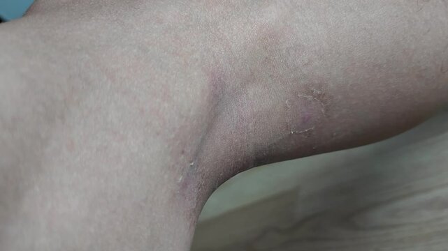 Paederus dermatitis, medically known as dermatitis linearis. You will feel burning pain, burn marks, and blisters or rashes. that looks like herpes or shingles. Footage Day 10 After get the medicine