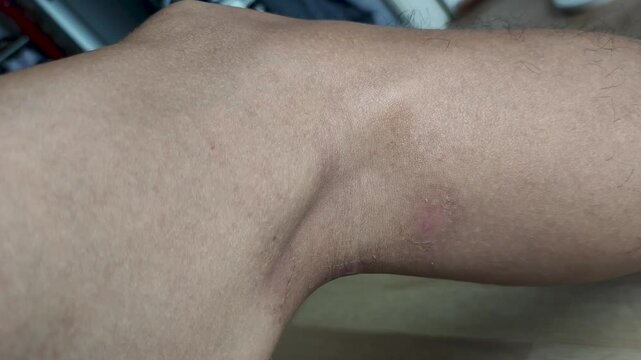 Paederus dermatitis, medically known as dermatitis linearis. You will feel burning pain, burn marks, and blisters or rashes. that looks like herpes or shingles. Footage Day 11 After get the medicine