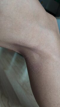 Paederus dermatitis, medically known as dermatitis linearis. You will feel burning pain, burn marks, and blisters or rashes. that looks like herpes or shingles. Footage Day 14 After get the medicine