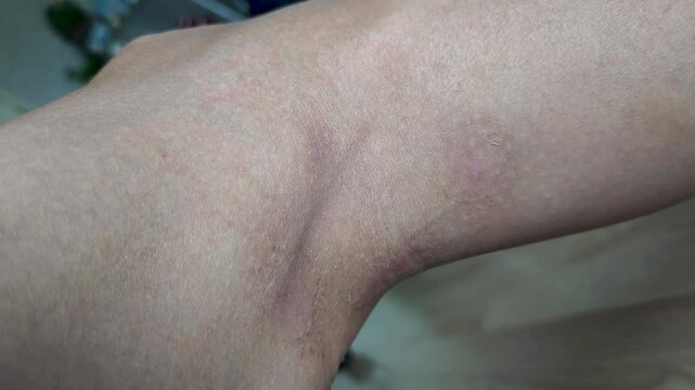 Paederus dermatitis, medically known as dermatitis linearis. You will feel burning pain, burn marks, and blisters or rashes. that looks like herpes or shingles. Footage Day 12 After get the medicine
