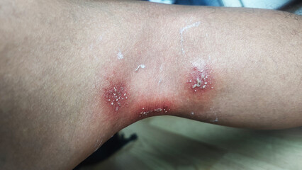 Paederus dermatitis, medically known as dermatitis linearis. You will feel burning pain, burn marks, and blisters or rashes. that looks like herpes or shingles. Footage After get the medicine