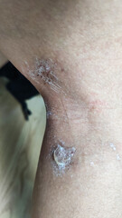 Paederus dermatitis, medically known as dermatitis linearis. You will feel burning pain, burn marks, and blisters or rashes. that looks like herpes or shingles. Footage After get the medicine