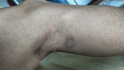 Paederus dermatitis, medically known as dermatitis linearis. You will feel burning pain, burn...