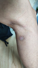 Paederus dermatitis, medically known as dermatitis linearis. You will feel burning pain, burn marks, and blisters or rashes. that looks like herpes or shingles. Footage After get the medicine