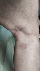 Paederus dermatitis, medically known as dermatitis linearis. You will feel burning pain, burn marks, and blisters or rashes. that looks like herpes or shingles. Footage After get the medicine
