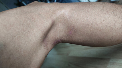 Paederus dermatitis, medically known as dermatitis linearis. You will feel burning pain, burn marks, and blisters or rashes. that looks like herpes or shingles. Footage After get the medicine