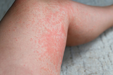 Allergic rash on the leg. Photodermatitis. Allergy to the sun, ultraviolet.