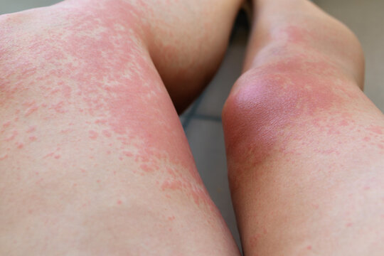 Allergic rash on the leg. Photodermatitis. Allergy to the sun, ultraviolet.