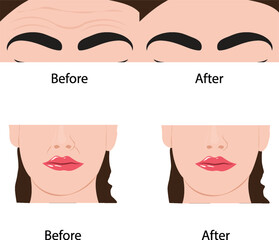 botox before and after illustration or clipart difference isolated on transparent background