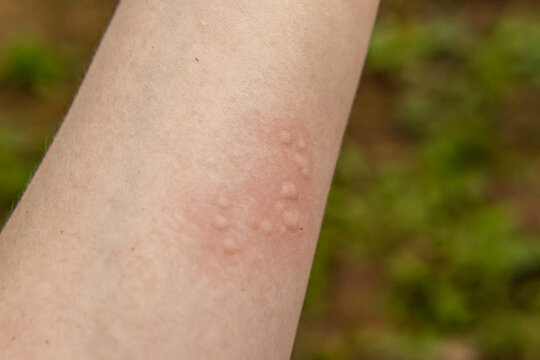 Red spots on the arm. Nettle burn. Allergic reaction on skin. Natural