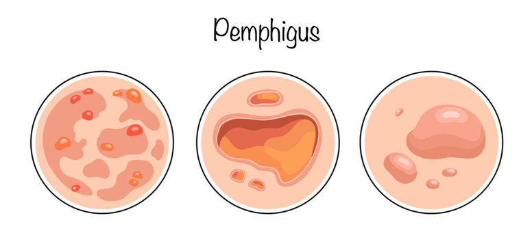 Pemphigus