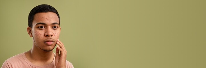 Obraz premium Young polynesian man scratched face with skin problems. Red spots on face, puberty, acne scars, allergic reaction. Dermatology facial cleaning wide banner with copy space at olive green background.