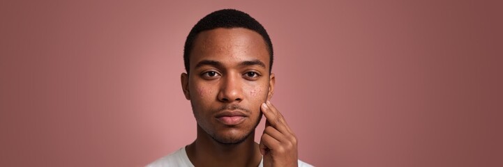 Fototapeta premium Young man scratched his face with skin care problems. Red spots on face, puberty, acne scars, allergic reaction. Dermatology facial cleaning wide banner with copy space at mocha mousse background.