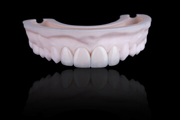 Four dental ultra-thin ceramic veneers in bleach color for fixation to frontal teeth of upper jaw. © gorynvd