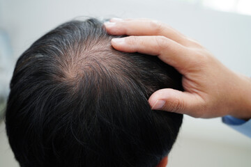 Naklejka premium Bald head in man, hair loss treatment health problem.