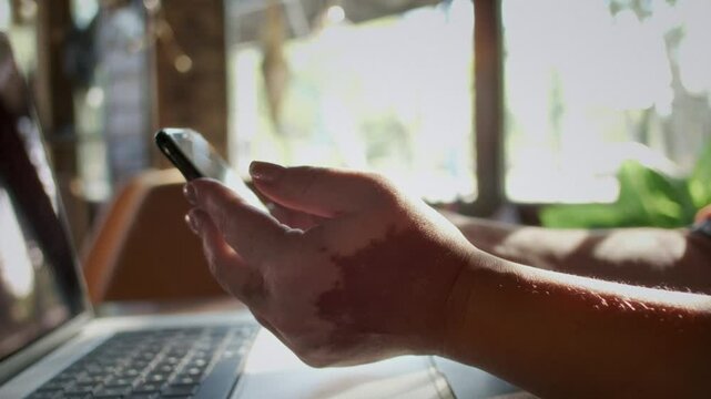 Aged woman with vitiligo holds smartphone above laptop at table closeup. Senior lady with skin disease scrolls newsfeed at home. Devices usage