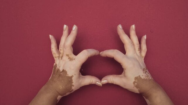 Old woman hands with vitiligo pigmentation show heart symbol of fingers on pink background closeup. Self love and positive attitude concept