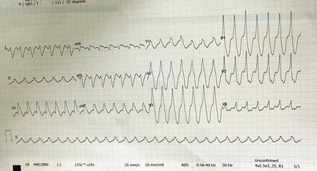 Atrial fibrillation in Wolff-Parkinson-White syndrome, WPW is a short PR interval and a “delta wave"