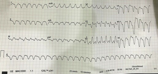 Ventricular Tachycardia – Monomorphic VT, VT vs SVT with Aberrancy 