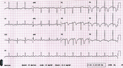 T wave inversion, myocardial ischemia and infarction , EKG 12 Lead,Anterior Myocardial Infarction,Old MI