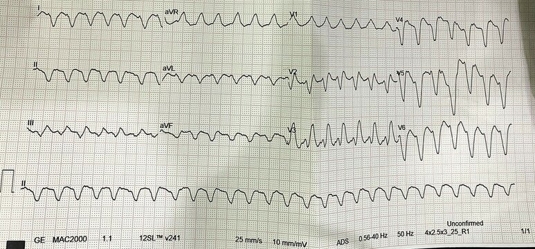 Ventricular Tachycardia &ndash; Monomorphic VT, VT vs SVT with Aberrancy 