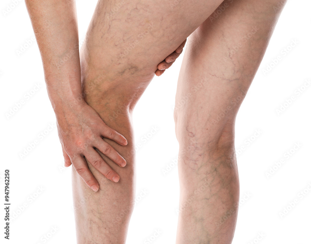 Wall mural Woman suffering from varicose veins on white background, closeup