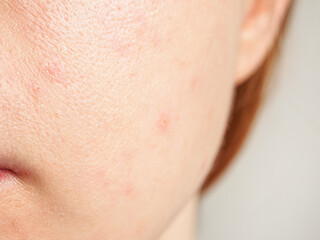 Close-up of acne skin showing problems: inflammation and rashes reflecting the condition of the face