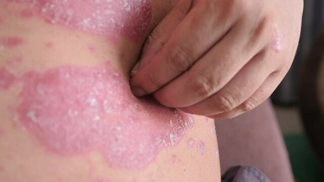 Scratching skin Psoriasis. Skin rach