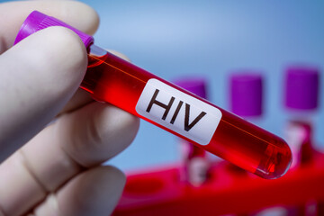 Blood collection tubes HIV test positive results,Medical health concept
