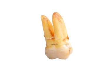 Close-up of extracted tooth with clipping path isolated on a white background. Macro photograph, real human teeth, tooth with caries