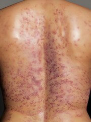 Fototapeta premium Rashes in the human back