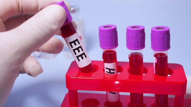 Eastern Equine Encephalitis (EEE) is an extremely rare but serious and often fatal infection that causes encephalitis or inflammation of the brain