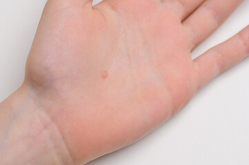 Naklejka premium Close-up of child's hand with warts on skin on white background. Pediatric dermatology concept. Papillomavirus. Verruca vulgaris. HPV.