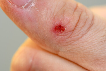 Fototapeta premium Thumb with a little bloody scratch. Man's injured finger. Wounded finger. Scratch on a skin. Close up view. 