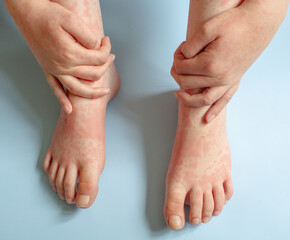 Teenager boy holding his ankles with red allergic rash on the feet and hands on skin of teenager from using antibiotics.