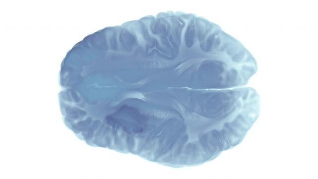 Ischemic Stroke in Left Frontal Lobe with Darkened Infarct on MRI